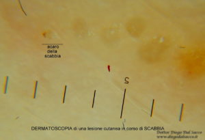 DERMATOSCOPIA di una lesione cutanea in corso di SCABBIA