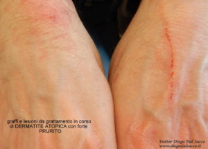 graffi e lesioni da grattamento in corso di DERMATITE ATOPICA con forte PRURITO
