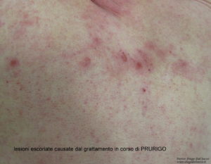 lesioni escoriate causate dal grattamento in corso di PRURIGO